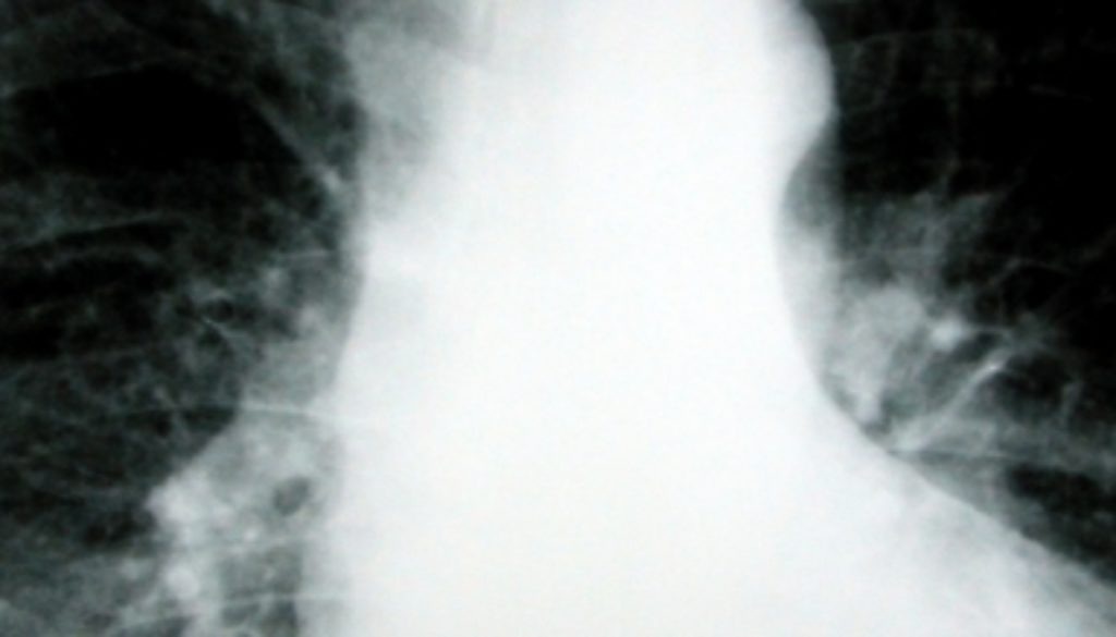 lung xray silica injury