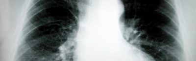 lung xray silica injury